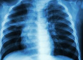 Image of chest X-ray