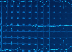 ECG