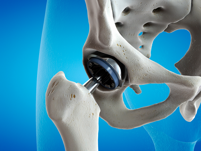 Hip replacement prostheses