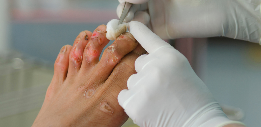 Injured raw skin toes being treated 